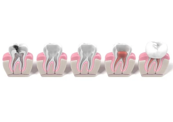 Endodoncia
